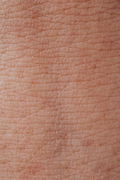 Skin showing inflammation and collagen breakdown caused by chronic excess sugar consumption